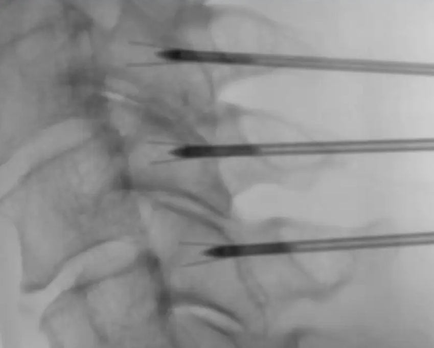 NIMBUS Çok Uçlu Genişleyebilir Elektrot